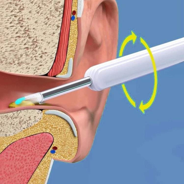 EarScope Pro Wax Removal Kit - Ear Wax Removal Kit - Wild Eye Vision